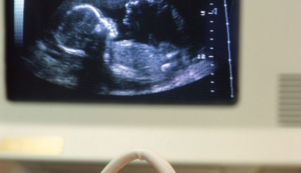 Μια έκτρωση αυξάνει τις πιθανότητες πρόωρου τοκετού