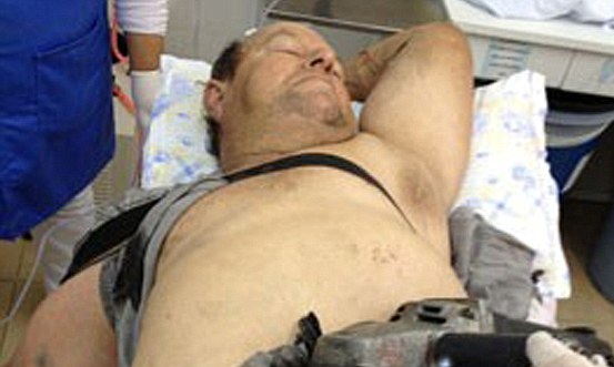 Του καρφώθηκε το δισκοπρίονο στην κοιλιά