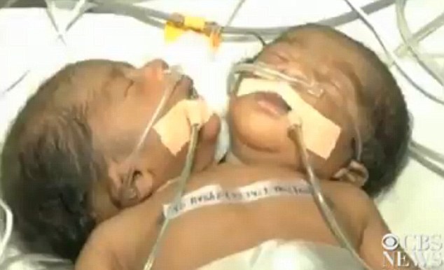 Γεννήθηκε μωρό με δύο κεφάλια στην Ινδία