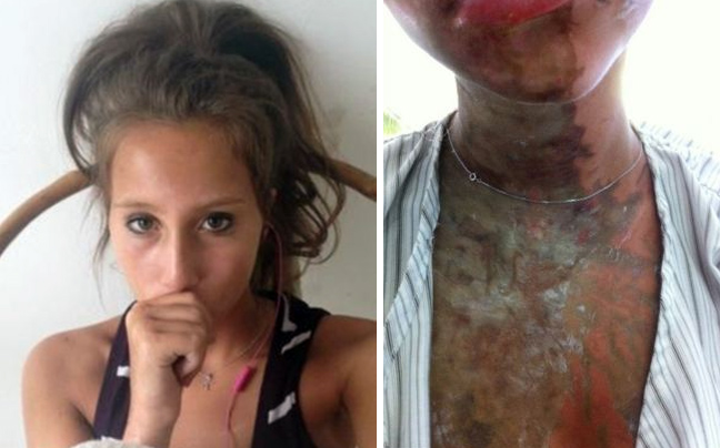 Έφηβες Βρετανίδες δέχθηκαν επίθεση με οξύ στη Ζανζιβάρη