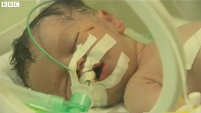 Πέθανε το «μωρό-θαύμα» της Γάζας