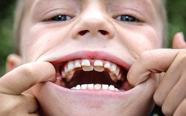 Οχτάχρονος έχει δύο σειρές δόντια!