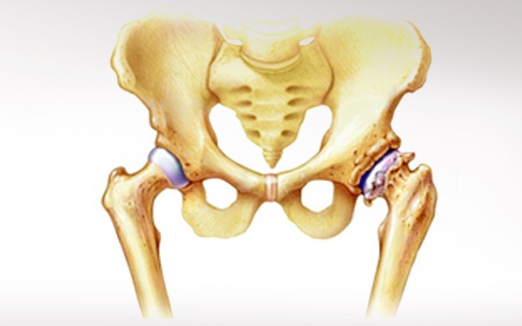 Οστεοαρθρίτις του ισχίου