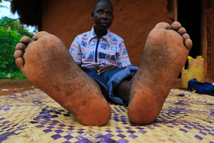 Ζώντας με ψύλλους που «τρώνε» τα πόδια στην Ουγκάντα