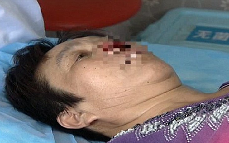 Άνδρας δάγκωσε, έκοψε και κατάπιε τη μύτη της πρώην γυναίκας του!