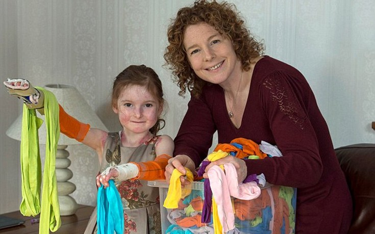 Το κορίτσι- πεταλούδα που το δέρμα του γεμίζει πληγές ακόμα και από μια αγκαλιά