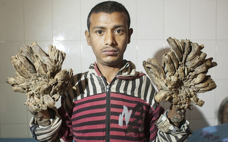 Ελπίζει σε θεραπεία ο «άνθρωπος-δέντρο» του Μπαγκλαντές