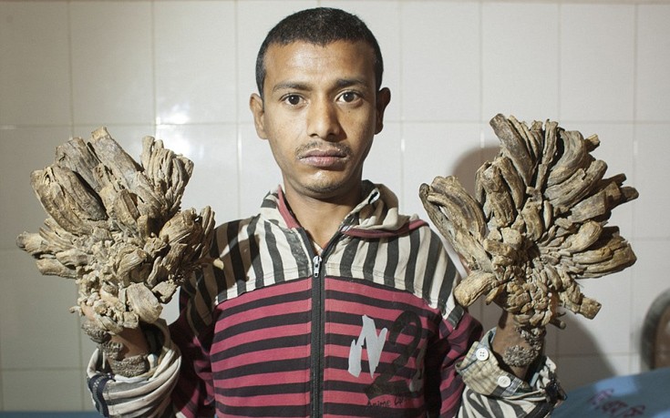 Στο χειρουργείο ο «άνθρωπος-δέντρο» του Μπαγκλαντές