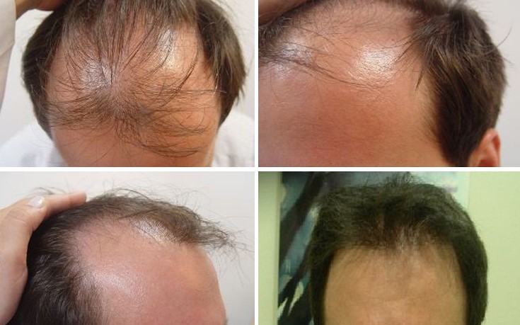 Μεταμόσχευση μαλλιών η μόνιμη λύση αποκατάστασης
