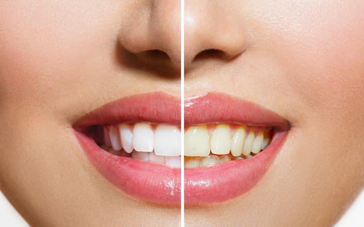 Ποιες τροφές κιτρινίζουν τα δόντια και τι μπορείτε να κάνετε γι’ αυτό