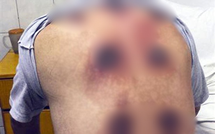 Πήγε να θεραπευτεί και έμεινε με τεράστιες τρύπες στην πλάτη του