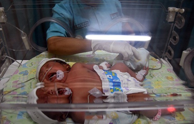 Μωρό με δύο κεφάλια γεννήθηκε στην Ινδονησία