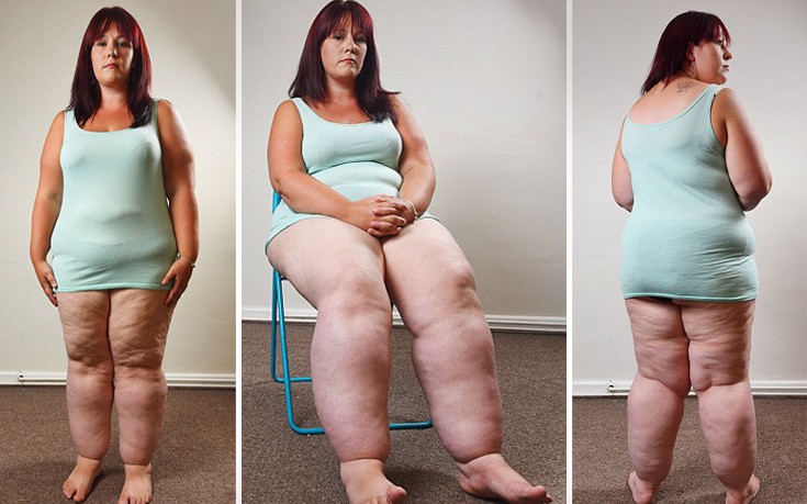 Η 29χρονη με τα πόδια που ζυγίζουν 50 κιλά