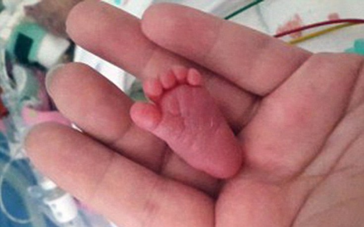 Η αγωνίστρια Emilia, το πιο μικρό πρόωρο μωρό στον κόσμο που τα κατάφερε