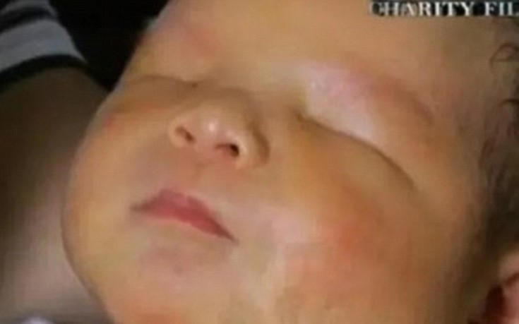 Το μωρό που γεννήθηκε χωρίς μάτια