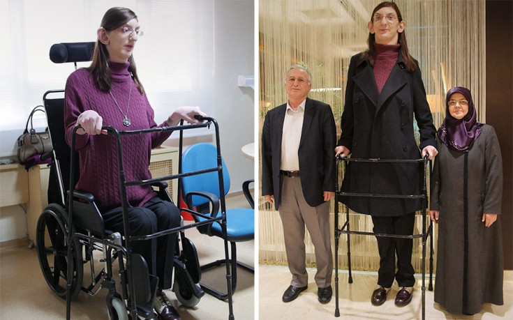Η έφηβη που είναι πολύ ψηλή… για να περπατήσει