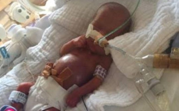 Το «εύθραυστο» μωρό που γεννήθηκε 510 γραμμάρια