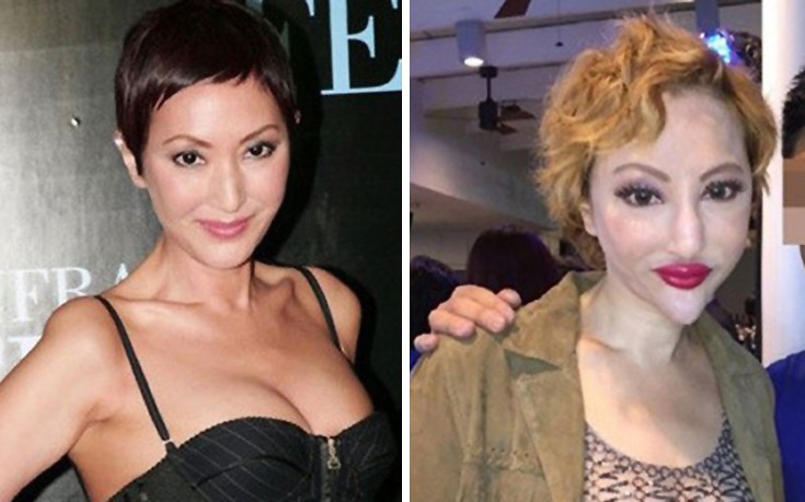 Πλαστικές επεμβάσεις που δεν πήγαν και πολύ καλά