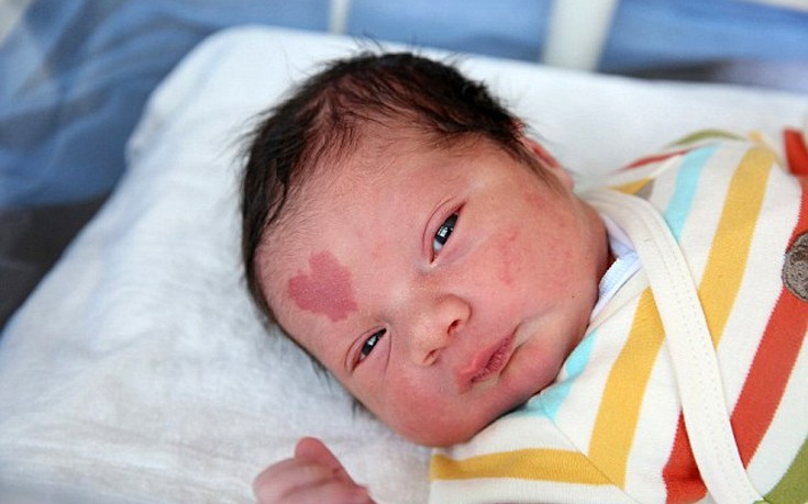 Μωρό στην Τουρκία γεννήθηκε με το σχήμα της καρδιάς στο μέτωπο