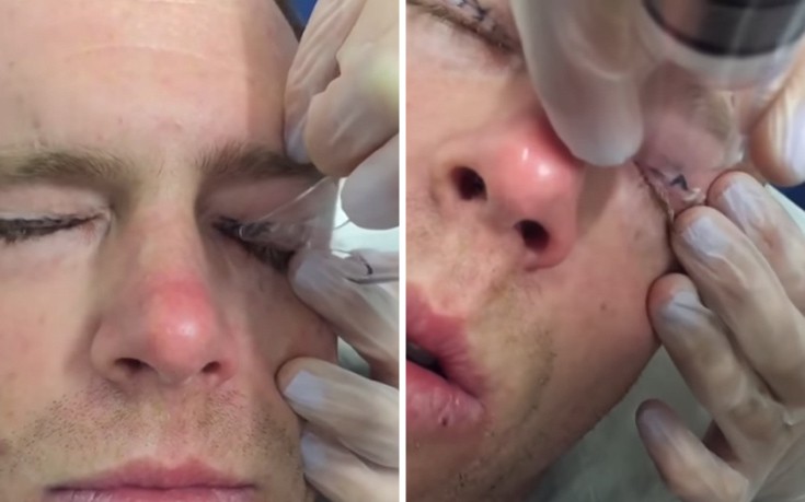 Έκανε τριήμερη κραιπάλη με τους φίλους του και ξύπνησε λίγο διαφορετικός