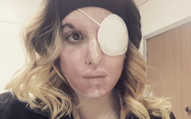 Η selfie της όμορφης Ιταλίδας μετά από επίθεση με οξύ στο πρόσωπο