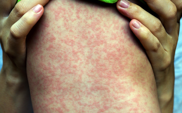ΠΟΕΔΗΝ: Υπάρχει έλλειψη αντιδραστηρίων για τον έλεγχο της ιλαράς
