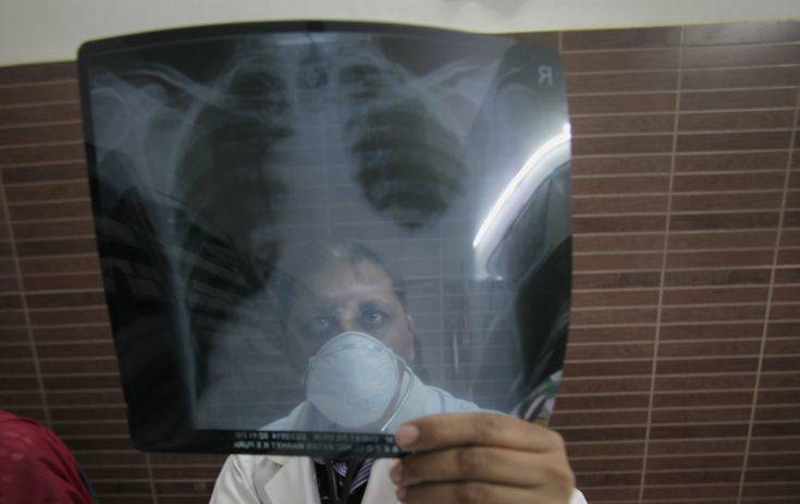 Η φυματίωση είναι παρούσα στην Ελλάδα, τονίζουν οι επιστήμονες