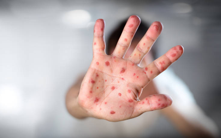 Βρετανία: Τα κρούσματα ιλαράς αυξήθηκαν, για «διαδικτυακές ασυναρτησίες» κάνει λόγο ο Τζόνσον