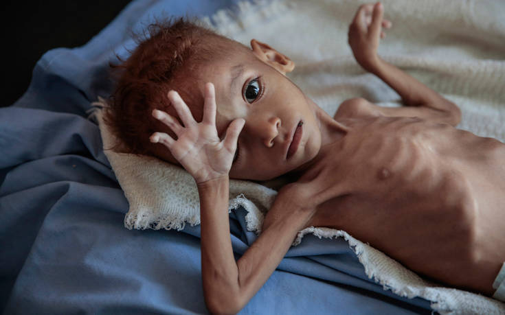 Το δράμα 5 εκατομμυρίων παιδιών στην Υεμένη που απειλούνται από λιμό