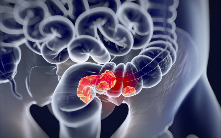 Άτομα κάτω των 30 ετών χτυπά ο καρκίνος του εντέρου