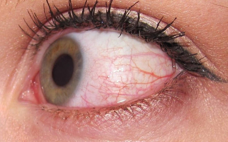Πέντε περιπτώσεις για να πας στον γιατρό αν έχεις κόκκινα μάτια