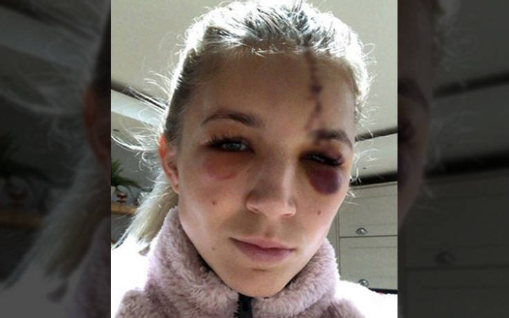 Σοκαριστικός τραυματισμός για την τερματοφύλακα της γυναικείας ομάδας της Λίβερπουλ