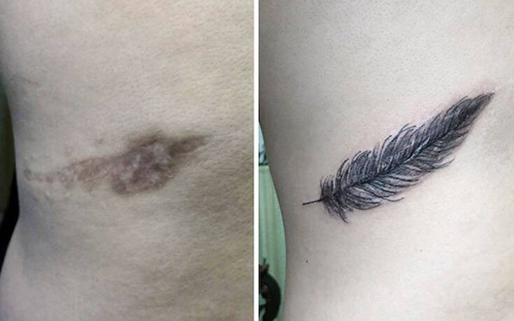 Σημάδια στο σώμα που έγιναν εντυπωσιακά τατουάζ