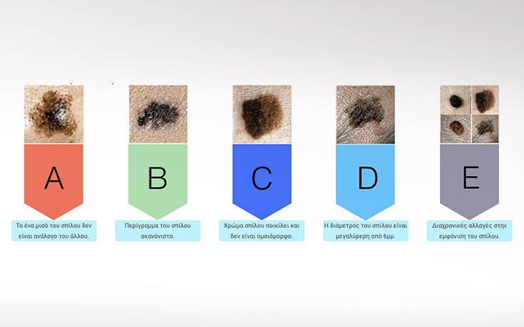 Όλα όσα πρέπει να γνωρίζετε για το μελάνωμα