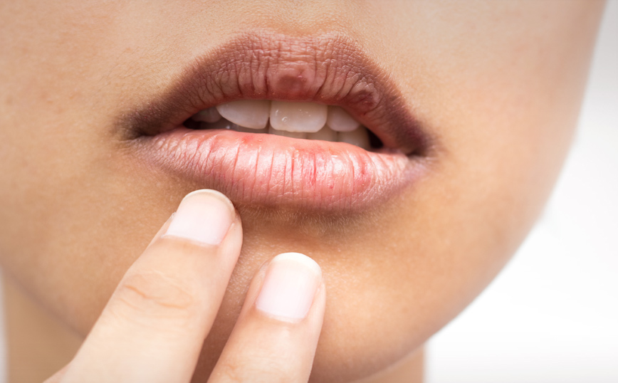 Πώς να περιποιηθείς τα σκασμένα χείλη σου το χειμώνα