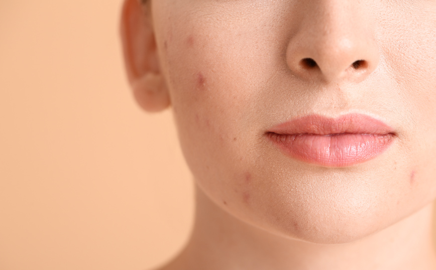 Το 48% των Ευρωπαίων έχει τουλάχιστον ένα δερματολογικό πρόβλημα &#8211; Τα συνηθέστερα