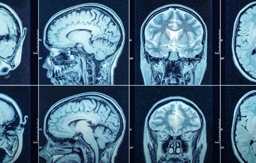 Μία μαγνητική εγκεφάλου Μία μαγνητική εγκεφάλου