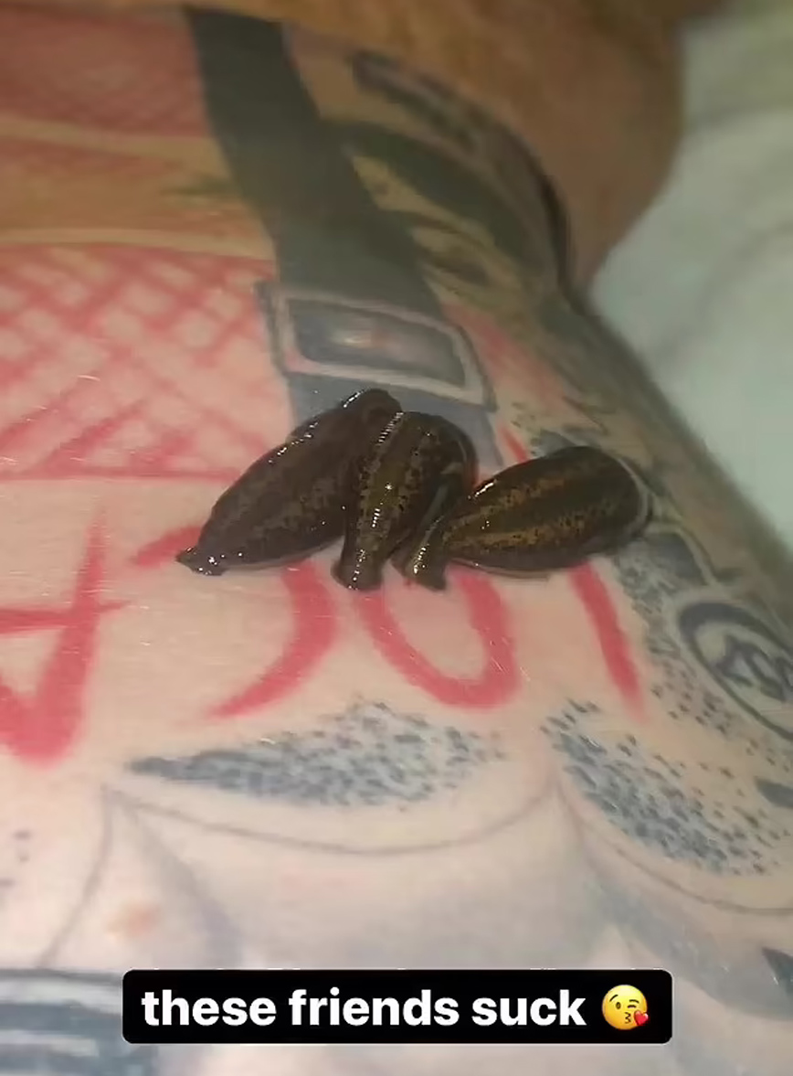 Βδέλλες σε σώμα με τατουάζ