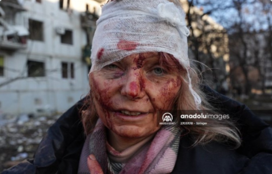 Εισβολή στην Ουκρανία: Ο πόλεμος σε μία συγκλονιστική φωτογραφία – Η γυναίκα με τα αίματα στο πρόσωπο