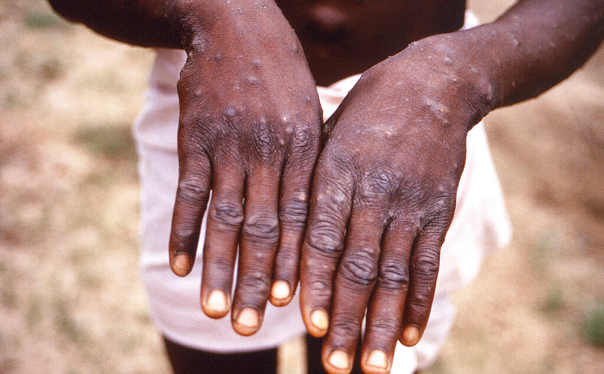 Ευλογιά των πιθήκων &#8211; Παγκόσμιος Οργανισμός Υγείας: Είναι απίθανο να εξελιχθεί σε πανδημία
