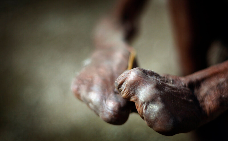 Άκρα μετά από λέπρα Άκρα μετά από λέπρα