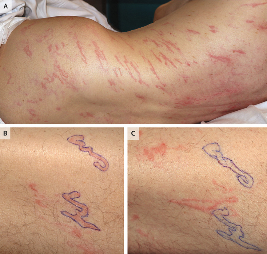 Το στρογγυλό σκουλήκι που ονομάζεται Strongyloides stercoralis Το στρογγυλό σκουλήκι που ονομάζεται Strongyloides stercoralis