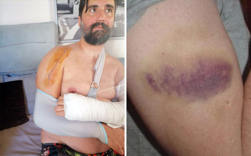 Σοκάρουν οι φωτογραφίες από τον ξυλοδαρμό διασώστη του ΕΚΑΒ: «Λεπτή η γραμμή μεταξύ ζωής και θανάτου» – Τι καταγγέλλει