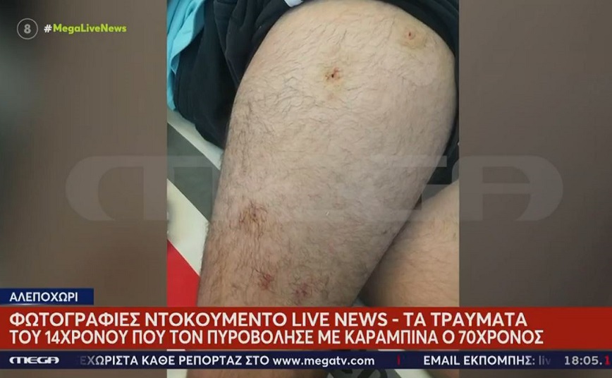 Αλεποχώρι: Φωτογραφίες – ντοκουμέντο από τα τραύματα του ανηλίκου μετά τους πυροβολισμούς του 70χρονου