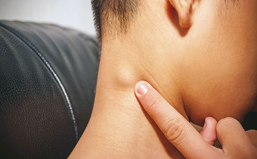 Πρησμένος λαιμός Πρησμένος λαιμός