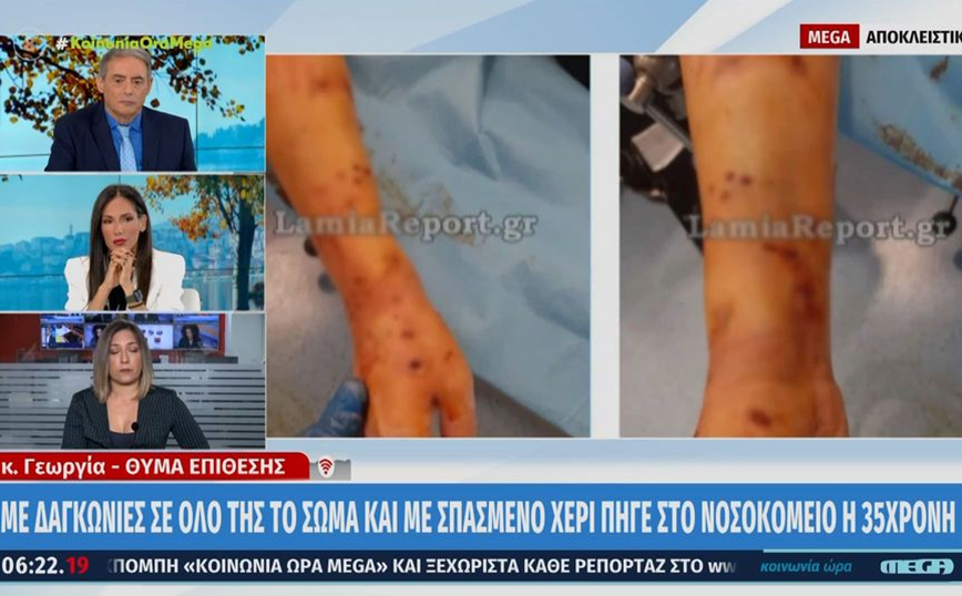 Λαμία: Αφόρητοι πόνοι για την 35χρονη μετά την επίθεση σκύλου – Αδιαφόρησε ο ιδιοκτήτης του ζώου, «θα του κάνω μήνυση»