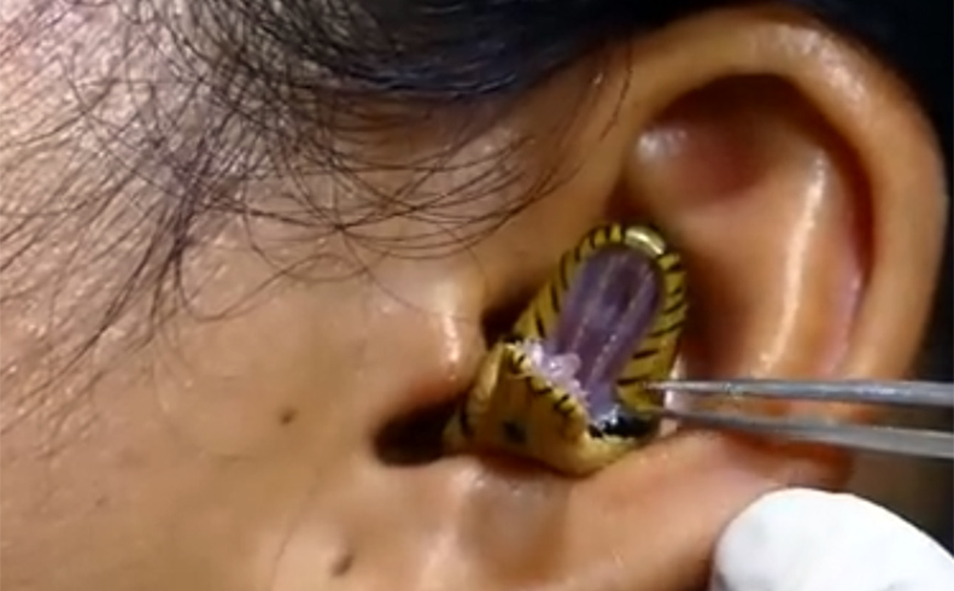 Ανατριχιαστικό βίντεο: «Χειρουργός» παλεύει να αφαιρέσει ζωντανό φίδι από το αυτί μιας γυναίκας