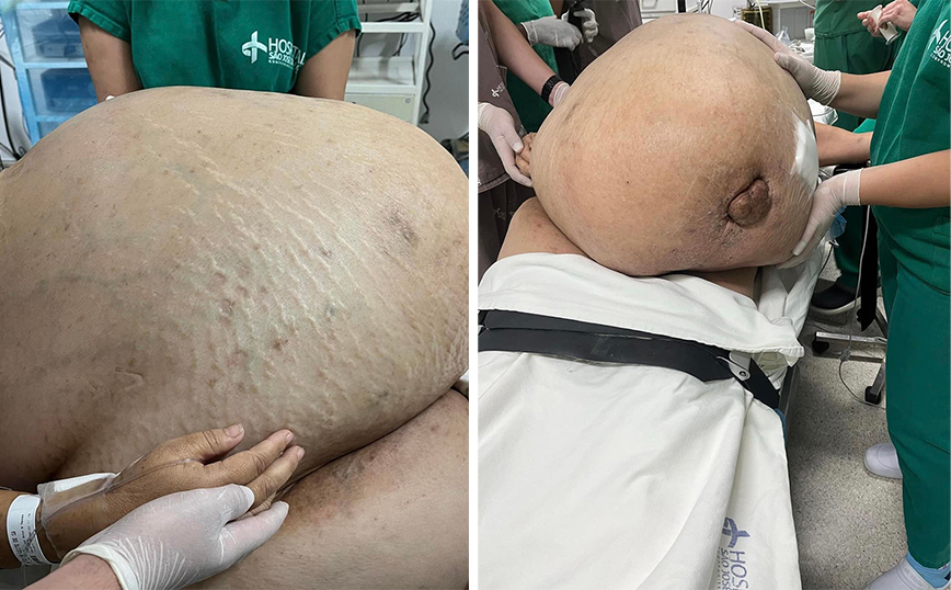 Γυναίκα είχε όγκο 45 κιλών για πέντε χρόνια – Οι γιατροί έμειναν έκπληκτοι με αυτό που αντιμετώπισαν