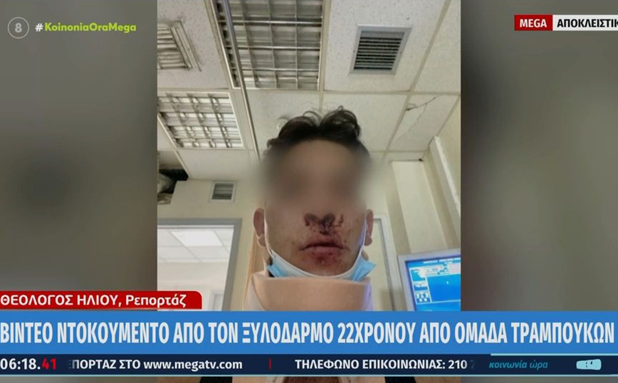 Θεσσαλονίκη: Ξυλοκοπήθηκε άγρια 22χρονος – Κατήγγειλε ότι τον χτύπησαν 10 άτομα
