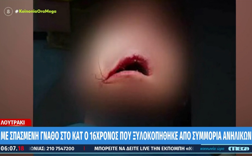 Λουτράκι: Σοκάρουν οι εικόνες από τον ξυλοδαρμό 16χρονου στο ΕΠΑΛ – Με σπασμένη γνάθο στο ΚΑΤ